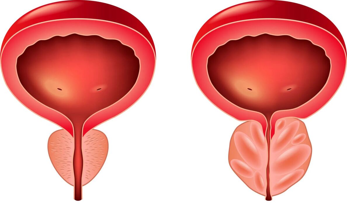 normálnu a chorú prostatu